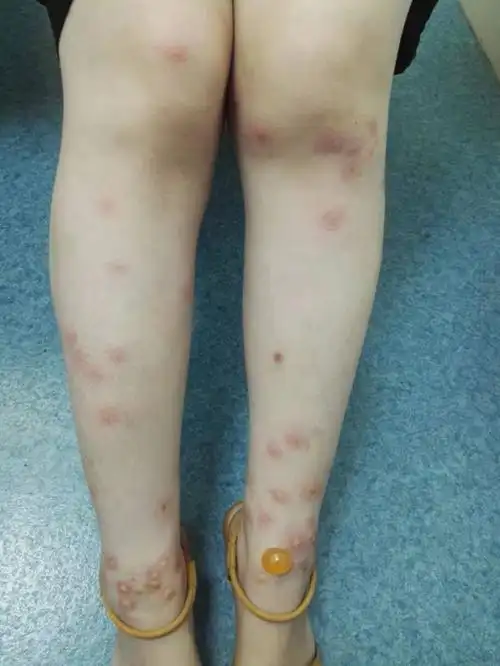 长沙女子全身长满红疹和水疱竟是办公区40多盆绿植引来蚊虫叮咬