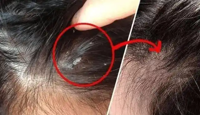 头皮出现芝麻大小的白色颗粒若管不住手下场会怎样