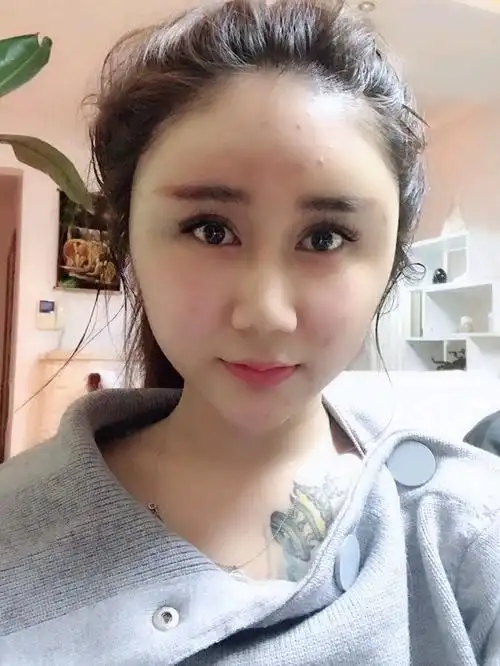 今天是自体脂肪填充15天了 我来汇报一下我的恢复情况