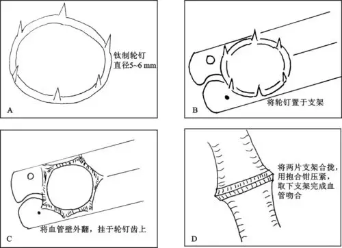图13-6 钛轮钉法血管吻合技术(a～d)