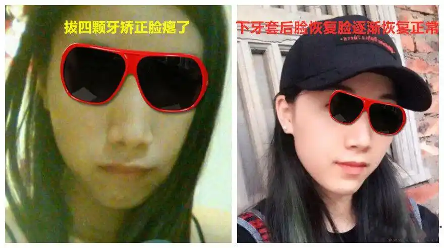 拔了四颗牙脸瘪了?知道了这些 你才能有效避免!