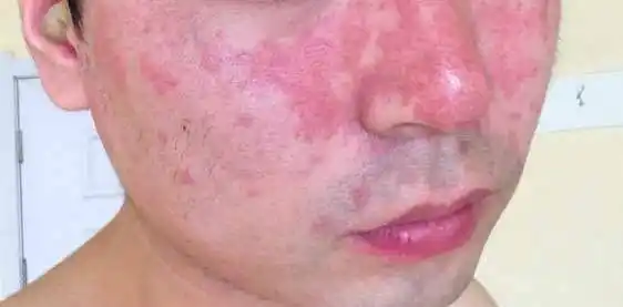 长春肤康医院浅谈:牛皮癣长在面部怎么办?这些措施可帮助你慢慢改善