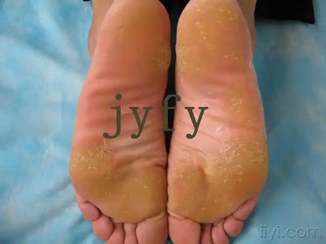 点状掌跖角化症