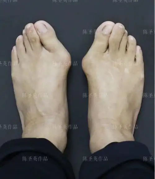 陈圣英:脚孤拐大就是"苦命脚"?这其实是种病,很轻松就能治