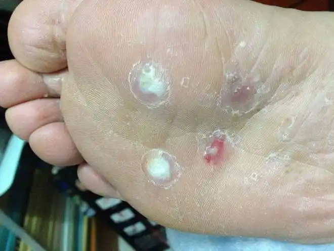 脚上长鸡眼是怎么回事和跖疣有何不同该怎么去除一文说清