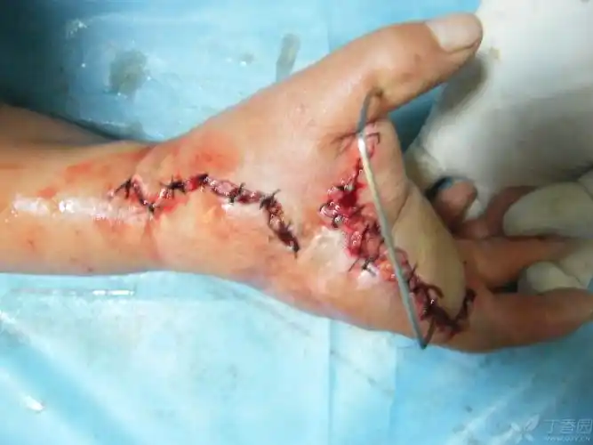 受区吻合血管后