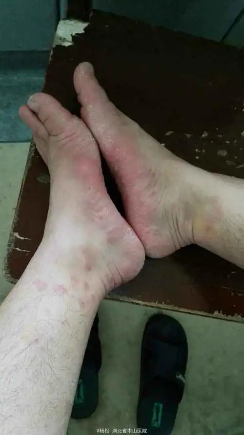 反复发作足癣一例