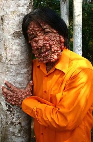 【讨论】男子浑身肿瘤疯长向世界求医