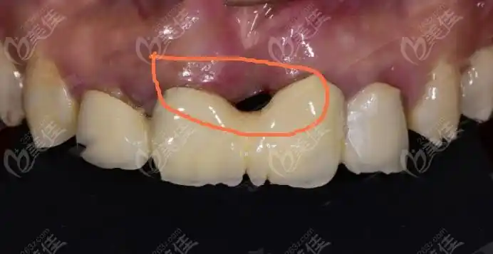 如果种植牙过了20年坏了怎么办?还能再种吗?