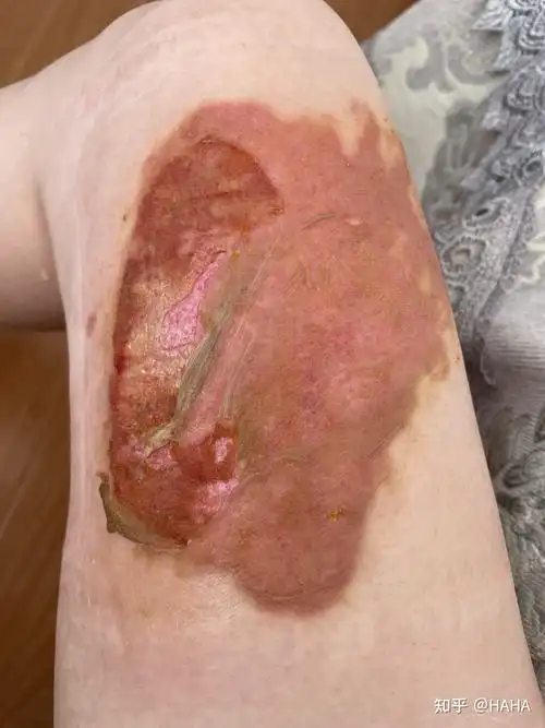 烫伤自我在家换药过程 - 知乎