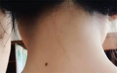 脖子上有痣的男人代表什么