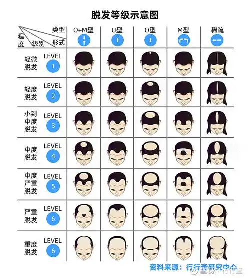 脱发的等级