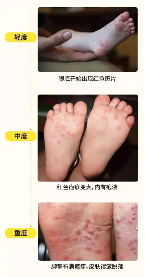 写美篇  虽然说大部分的手足口可以自愈,但发病的过程却又痒又疼