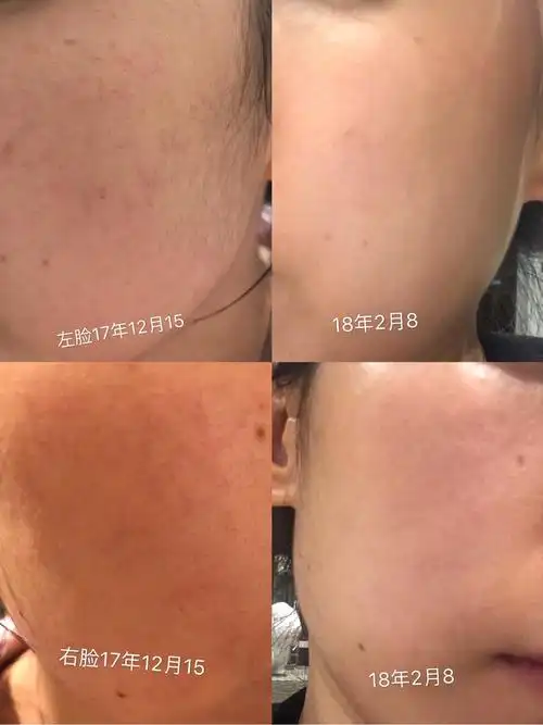 超干货我的敏感红血丝肌肤大作战