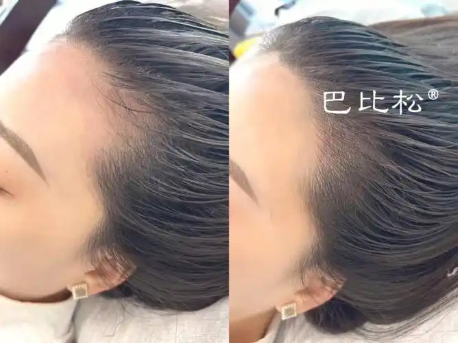 上海纹发际线天花板告别发际线粉