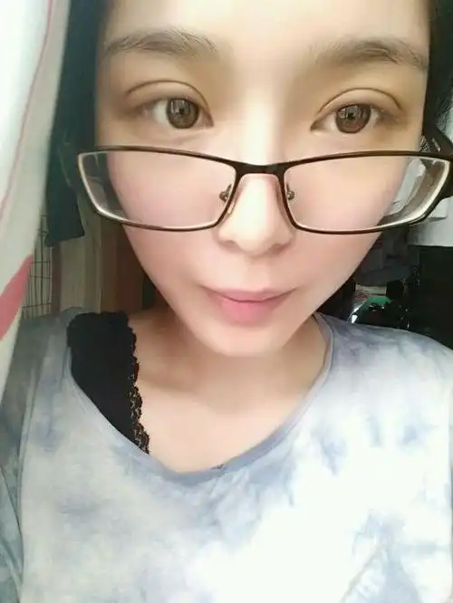 全切双眼皮恢复一个月半都说比较自然了嘻嘻