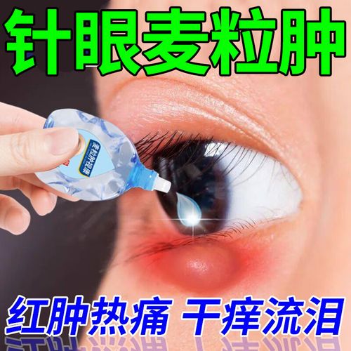 麦粒肿眼药水眼针睑板腺堵塞眼睑红肿痒脓痛视物模糊异物感眼俭炎