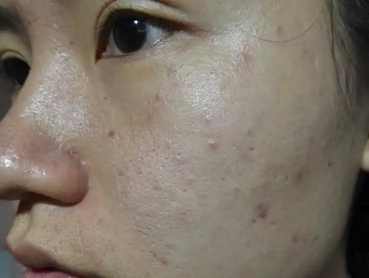 皮肤暗沉 油光满面 毛孔粗大 汗毛多 痘痘又多 黑头 唇上面有痘印