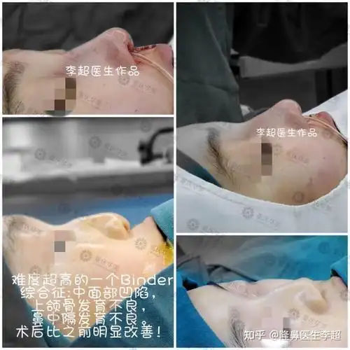 浅谈"binder综合症",一种你可能没听说,但绝对熟悉的颅颌面疾病.