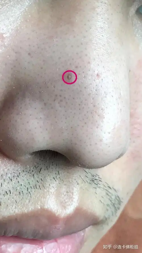 请问鼻子上这种大黑头该怎么处理!? - 知乎