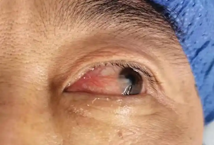 的眼睛内眼角总是红红的 黑眼球上长了一块"余肉" 我们叫它为翼状胬肉