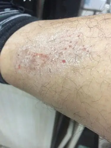 这是一种什么样的皮肤病? 怎么治?传不传染?