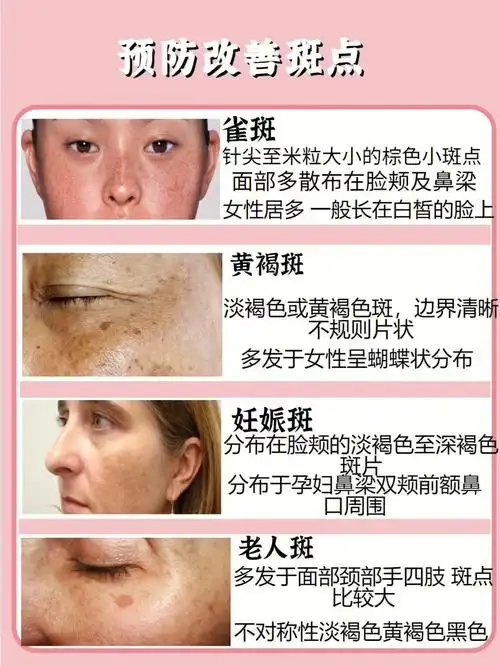 98今天就帮大家来理一下不同类型祛斑美白