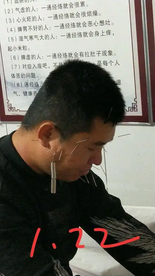 面神经麻痹针灸临床实践