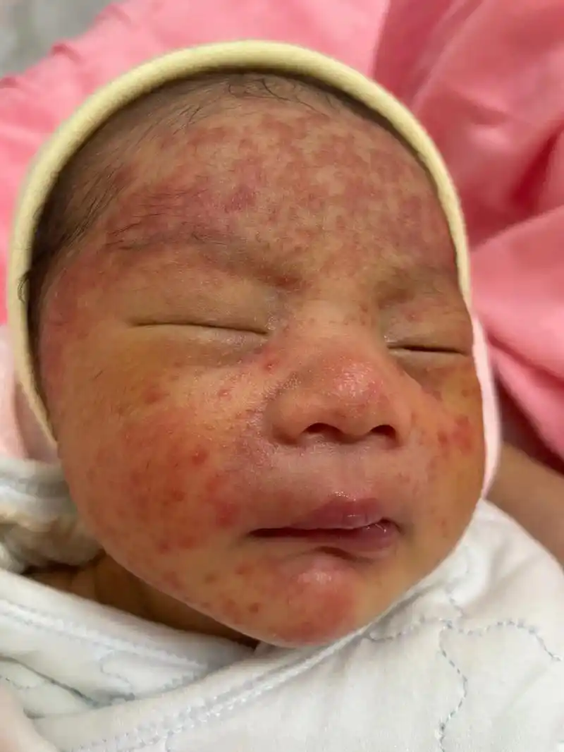 反反复复小湿疹,一切的一切全靠这个,蛋白质过敏,不是大便出血 - 抖音