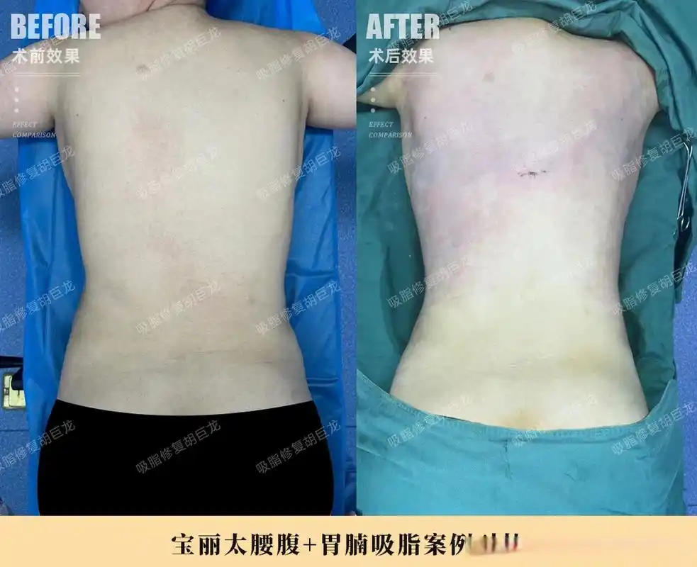 腰腹吸脂 胃腩 妈妈臀 宝丽太术后即刻案例对比   这位宝妈因妊娠过后