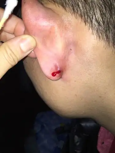 两个耳耳垂位置长期都长这种脓包,又很疼,这是怎么回事?