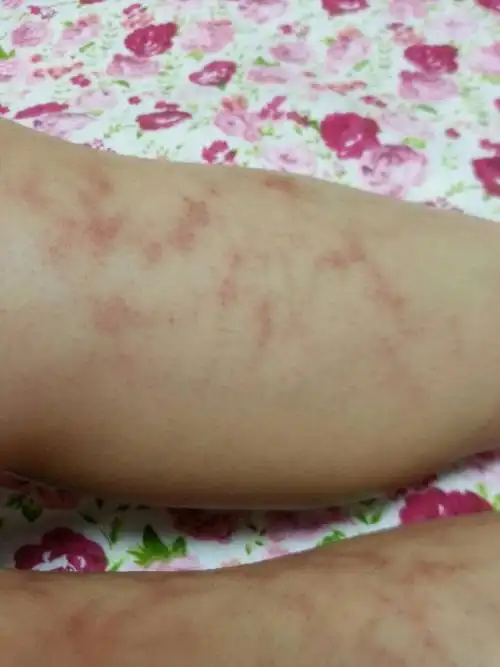 最近发现小腿上出现了一些红斑,不痛也不痒,这是不是冻的啊?