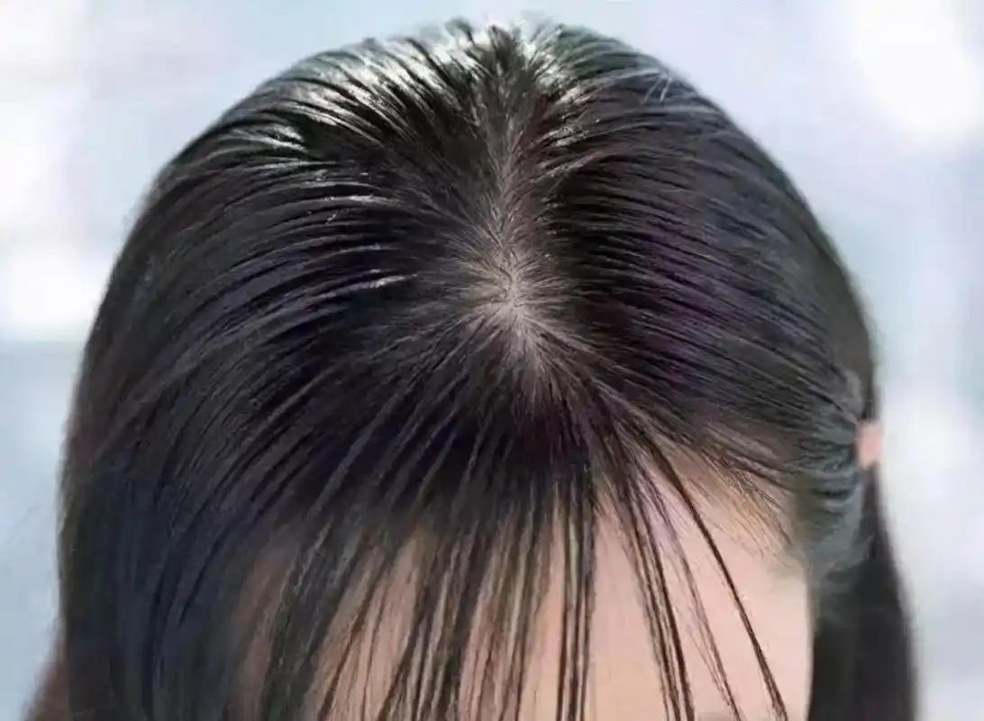 出油|头皮|头发_新浪新闻