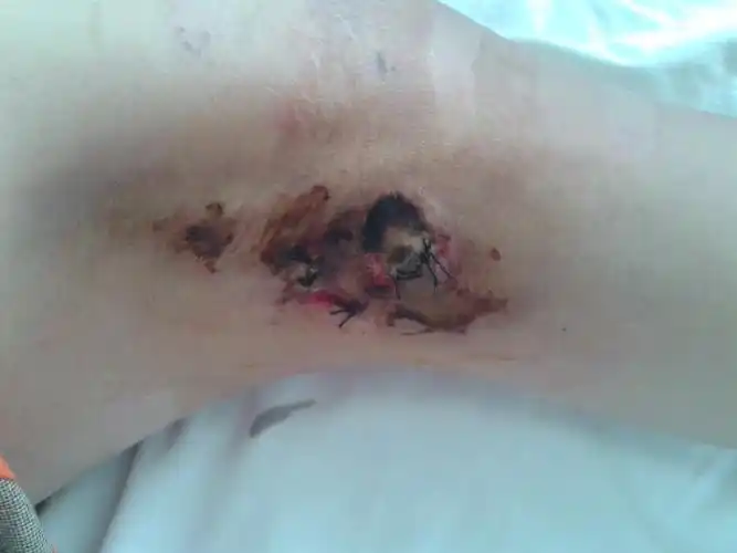 腋臭术后双侧腋下局部皮肤坏死相当着急