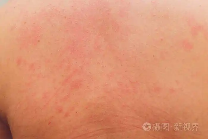 病人身上的过敏性皮疹