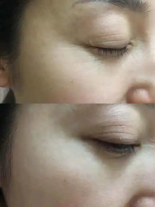 孕妇的黑眼圈眼袋泪沟细纹还有救吗?