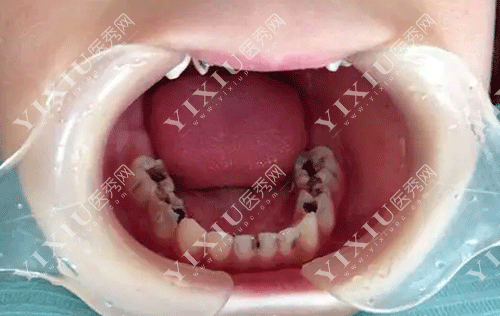 儿童牙齿蛀牙图片