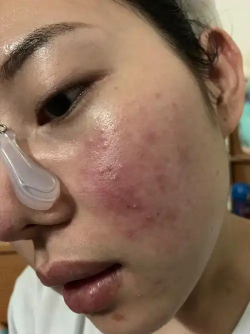 这个皮炎是要从2016年开始因为脸部长了一颗很上火发炎的痘