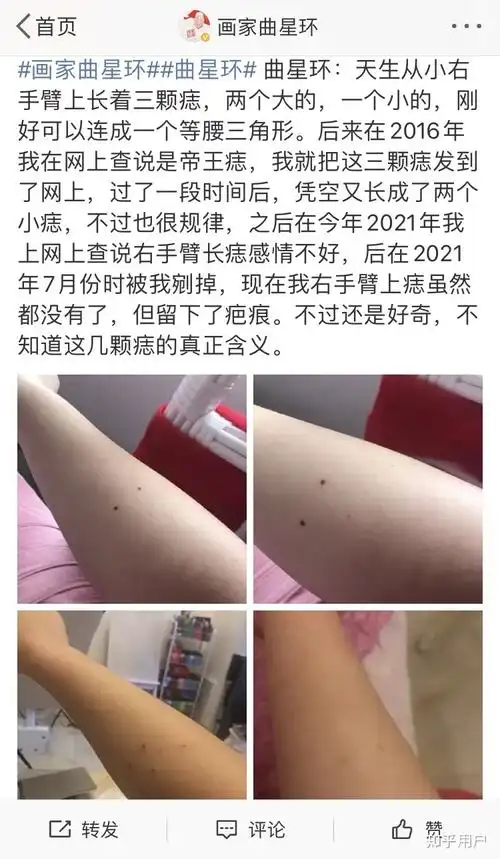 画家曲星环右手臂上是不是有三颗痣能连成等腰三角形? - 知乎