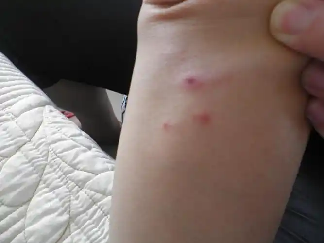 请专家帮忙看看,是不是系统性红斑狼疮的皮疹 - 皮肤及性传播疾病讨论