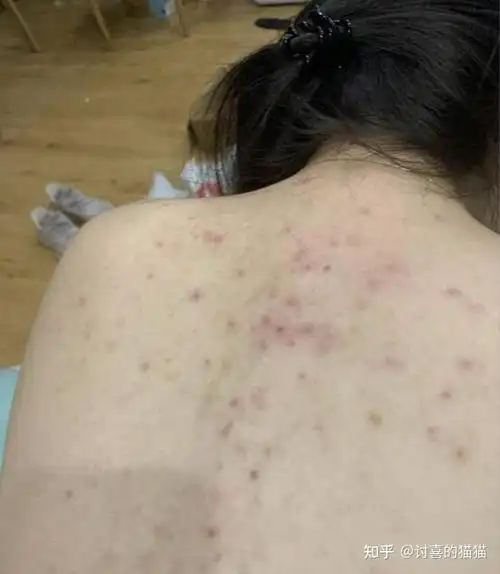 背上长痘怎么办终于找到了背后痘痘克星