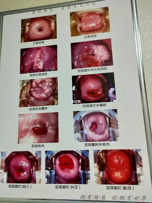 宫颈糜烂_六盘水自由行热门攻略_妇科炎症_清洁_炎症_经期_医疗健康