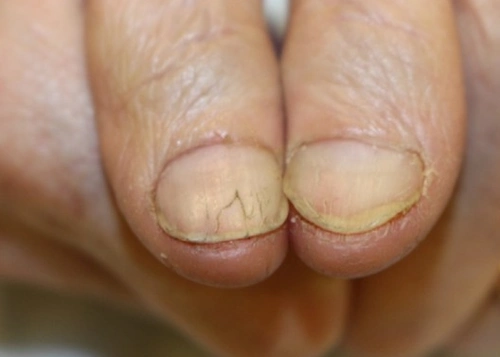 心脏不好的人,指甲会有4表现,若没有,恭喜你心脏功能还不错