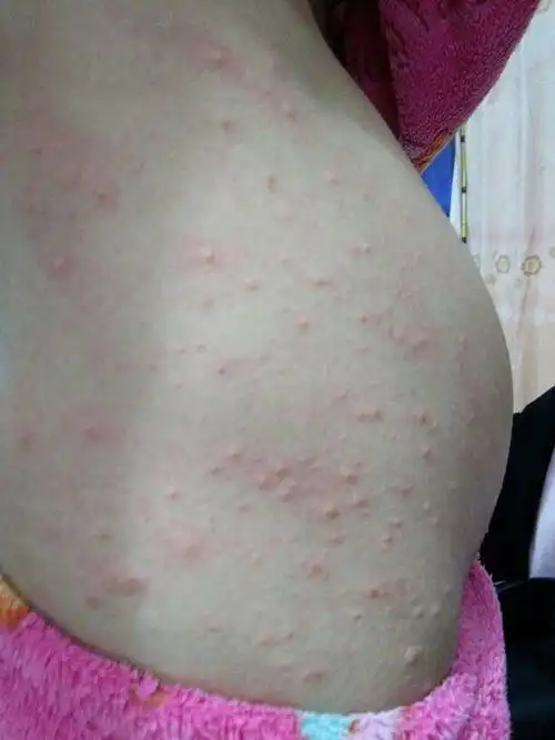 怀孕五个月患有毛囊炎,可以用白醋搽洗患处或则洗澡吗?