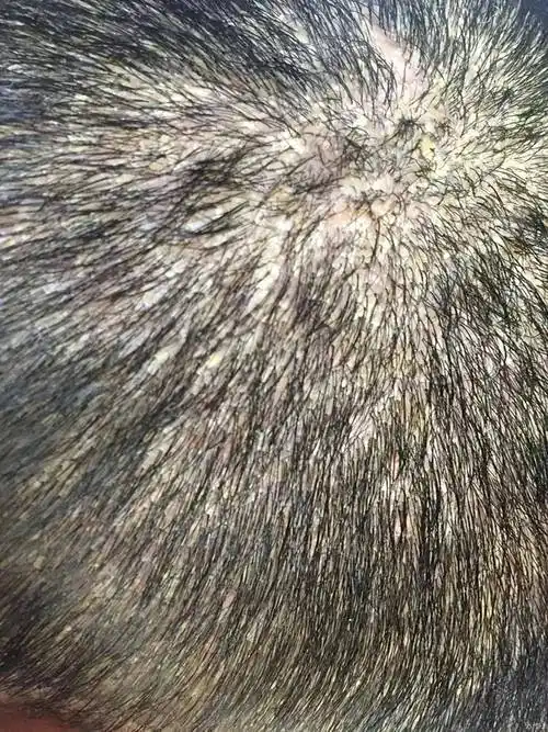 昆明时凡学头皮管理:头皮屑多是什么导致的_情况_是一种_摩丝