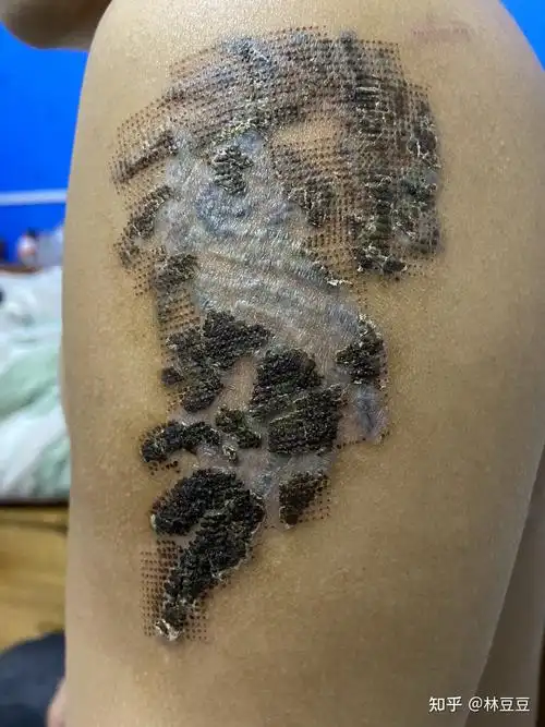 洗纹身恢复过程