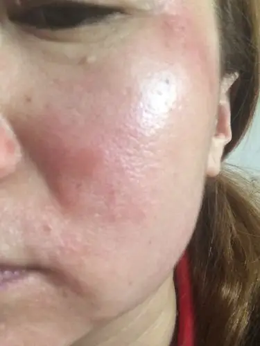 我的面部是沫化妆品过敏了.请问怎么医冶.涂抹什么药膏.