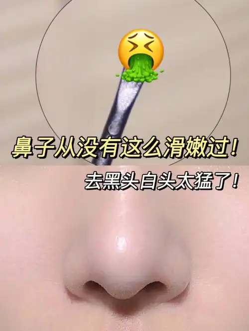 今天是一个有点味道的分享想要分享我鼻子上的一个陈年黑头它已经烦了