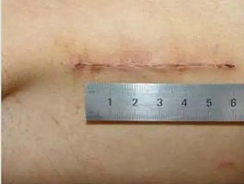 郑州大学五附院心胸外科完成一例成人右腋下美容小切口治疗先心病