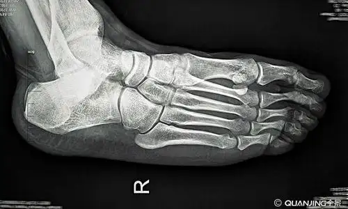 医学x光片脚掌骨骼_全景网
